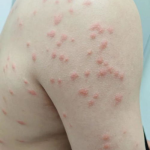 丘疹性荨麻疹图片,症状、病因与防治要点